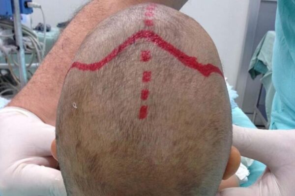 Bebê com doença rara consegue cirurgia de R$ 500 mil através do SUS bebe-com-doenca-rara-consegue-cirurgia-de-r$-500-mil-pelo-sus