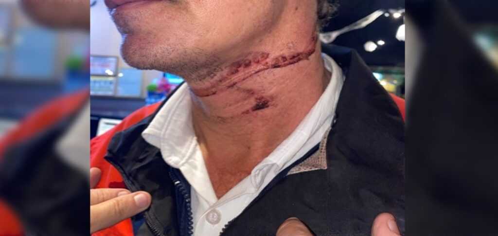 Fio pendurado deixa mais um motociclista ferido em Votuporanga fio-pendurado-deixa-mais-um-motociclista-ferido-em-votuporanga